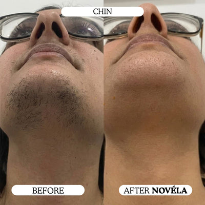 Finer, Fewer Facial Hairs in 30 Days With the Novéla Root System