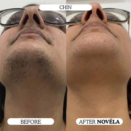 Finer, Fewer Facial Hairs in 30 Days With the Novéla Root System