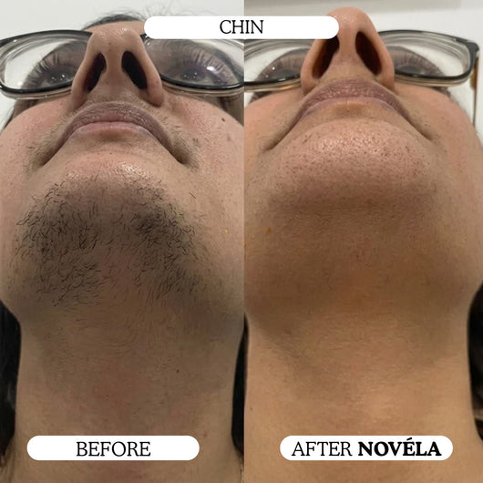 Finer, Fewer Facial Hairs in 30 Days With the Novéla Root System
