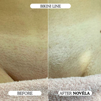 Finer, Fewer Facial Hairs in 30 Days With the Novéla Root System