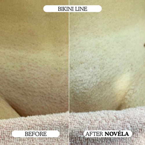 Finer, Fewer Facial Hairs in 30 Days With the Novéla Root System