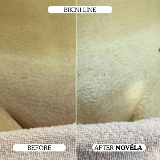 Finer, Fewer Facial Hairs in 30 Days With the Novéla Root System